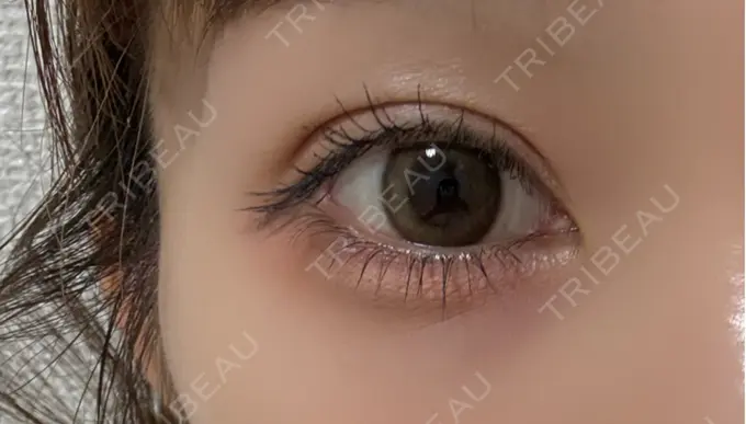 二重埋没 アリエル美容クリニック 横浜院 DAY 21 メイン用