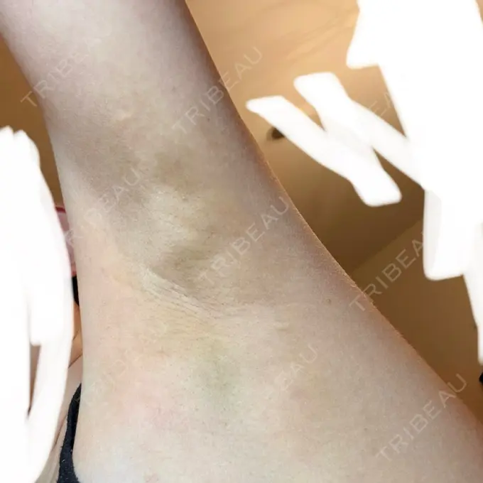 ワキ汗治療（レーザー） Fellez Clinic【フェルズクリニック】 DAY 9 メイン用