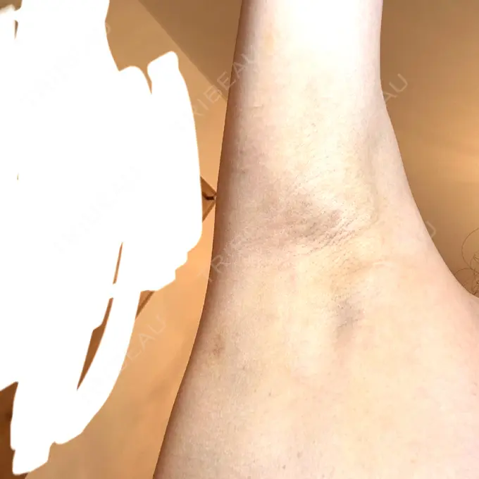 ワキ汗治療（レーザー） Fellez Clinic【フェルズクリニック】 DAY 10 メイン用