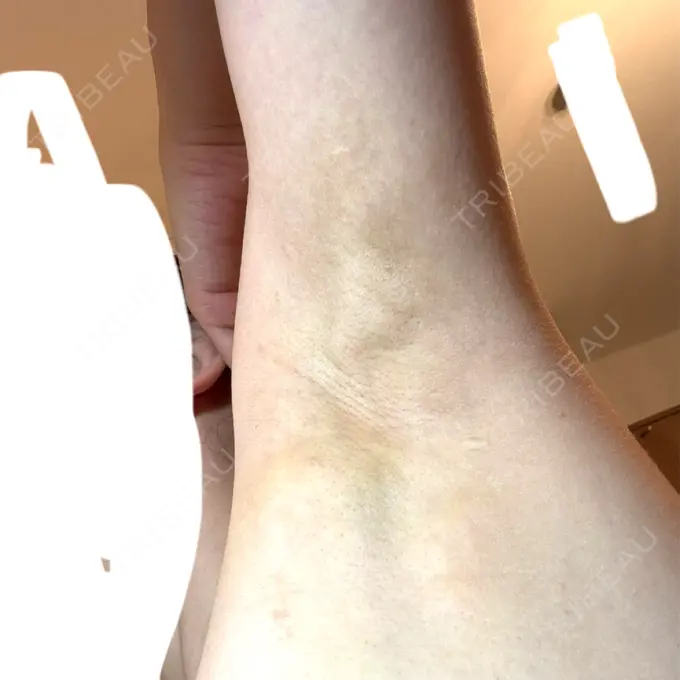 ワキ汗治療（レーザー） Fellez Clinic【フェルズクリニック】 DAY 10 メイン用