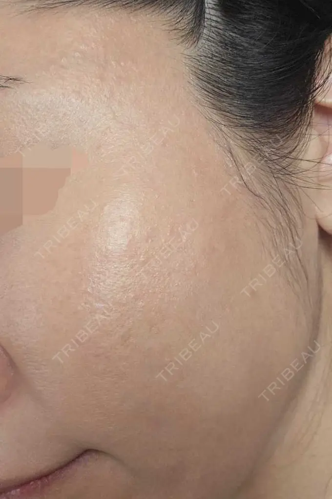 肌育注射（ジュベルックなど） L‘amour clinic Tokyo【ラムールクリニック東京】 DAY 24 メイン用