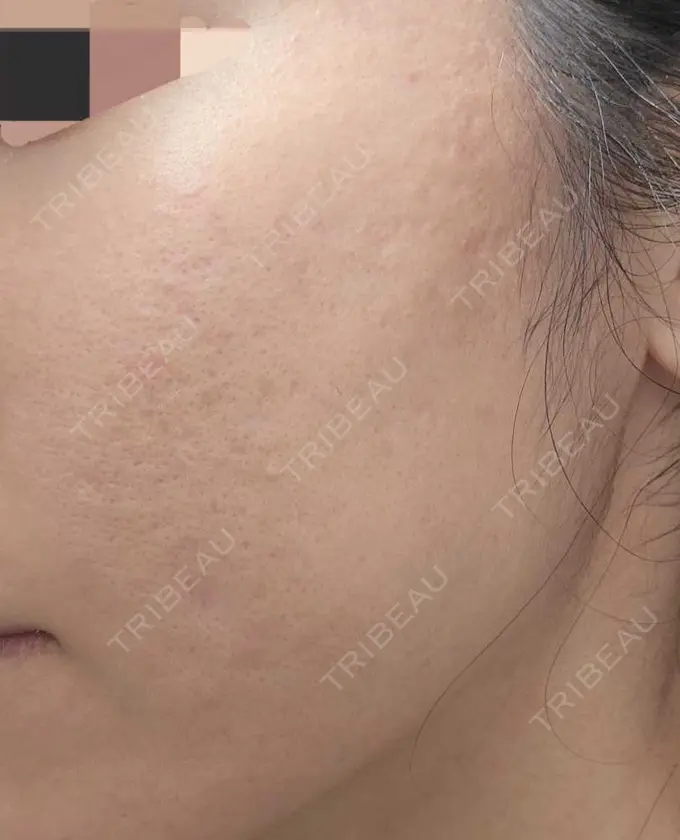 肌育注射（ジュベルックなど） L‘amour clinic Tokyo【ラムールクリニック東京】 DAY 25 メイン用