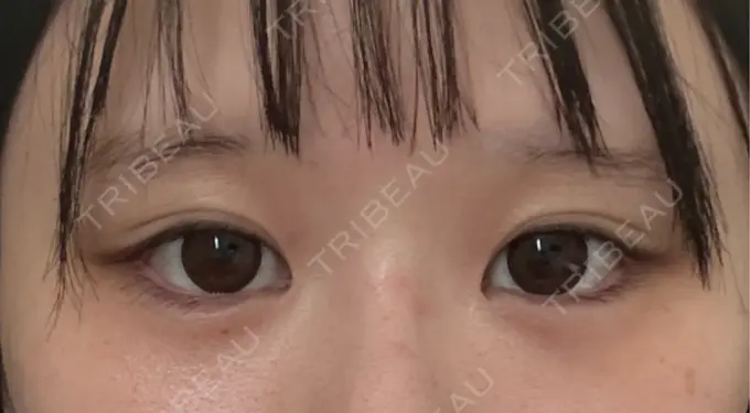 目尻切開 / タレ目形成・グラマラスライン（埋没） LOUIS CLINIC 二子玉川院【ルイクリニック】 DAY 11 メイン用