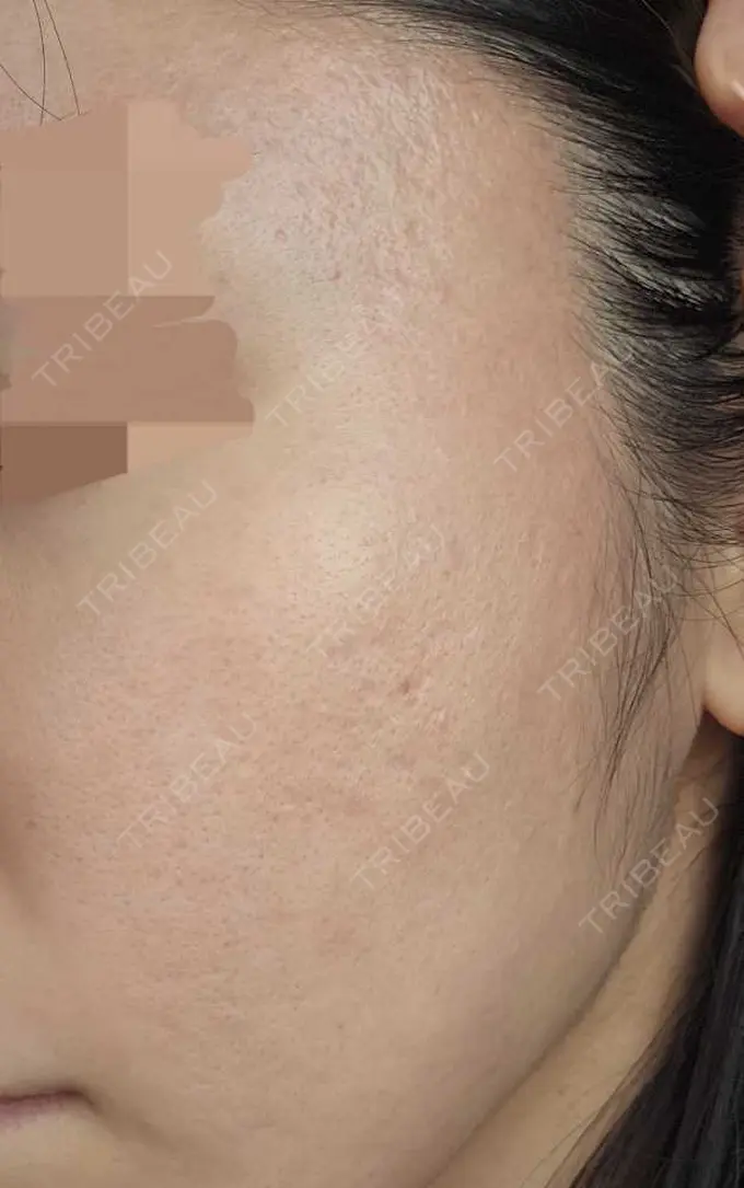 肌育注射（ジュベルックなど） L‘amour clinic Tokyo【ラムールクリニック東京】 DAY 26 メイン用