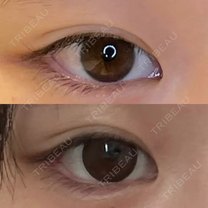 目尻切開 / タレ目形成・グラマラスライン（埋没） LOUIS CLINIC 二子玉川院【ルイクリニック】 DAY 10 メイン用