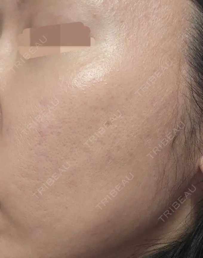 肌育注射（ジュベルックなど） L‘amour clinic Tokyo【ラムールクリニック東京】 AFTER メイン用