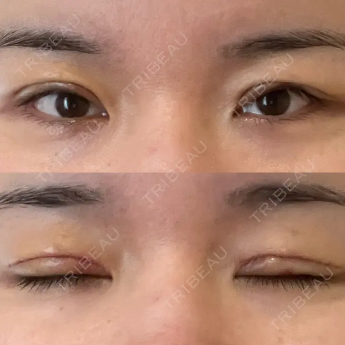 眼瞼下垂（切開） 博多もへじのクリニック DAY 6 メイン用