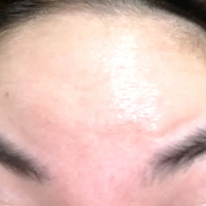 ボトックス（あご） / マイクロボトックス / ボトックス（眉間） / ボトックス（首） / ボトックス（ガミースマイル） M'sクリニック【エムズクリニック】 DAY 5 メイン用