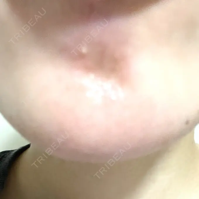 ボトックス（あご） / マイクロボトックス / ボトックス（眉間） / ボトックス（首） / ボトックス（ガミースマイル） M'sクリニック【エムズクリニック】 DAY 5 メイン用