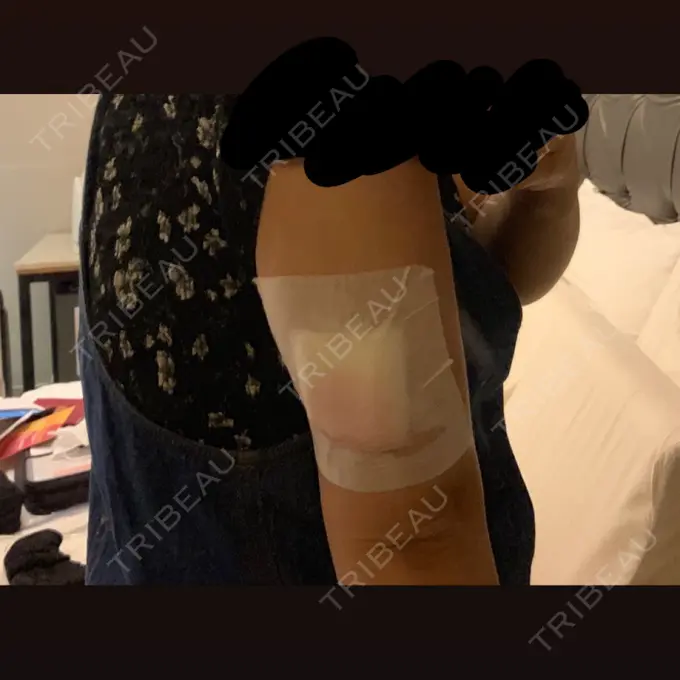 脂肪溶解注射（二の腕） / その他（ボディ） チョンダムジュエンクリニック DAY 1 メイン用