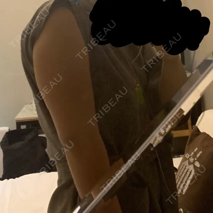 脂肪溶解注射（二の腕） / その他（ボディ） チョンダムジュエンクリニック DAY 1 メイン用