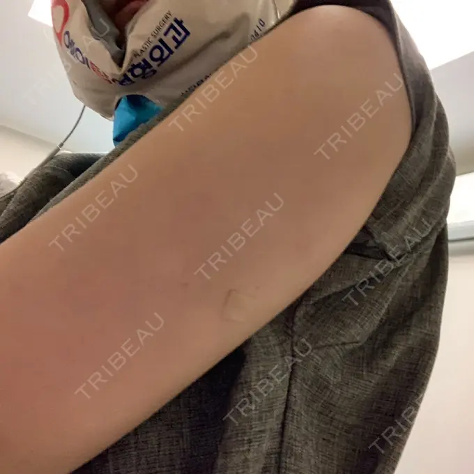 脂肪溶解注射（二の腕） / その他（ボディ） チョンダムジュエンクリニック DAY 1 メイン用