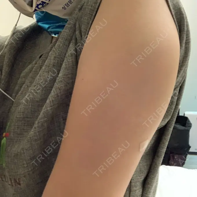 脂肪溶解注射（二の腕） / その他（ボディ） チョンダムジュエンクリニック DAY 1 メイン用