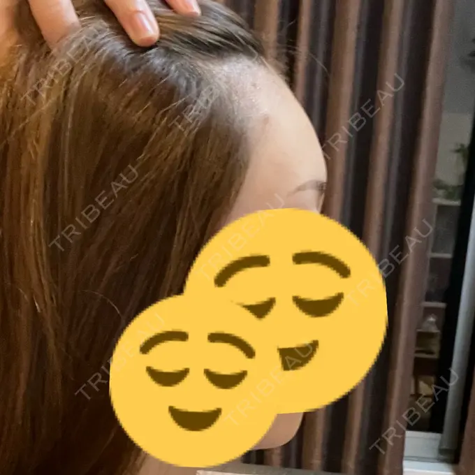 ヒアルロン酸注入（額） アモーレクリニック 名古屋院 DAY 13 メイン用