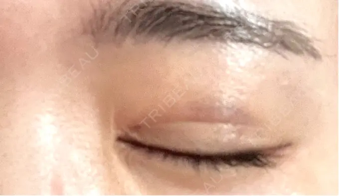 二重埋没 OMI CLINIC 【オミクリニック】 DAY 2 メイン用