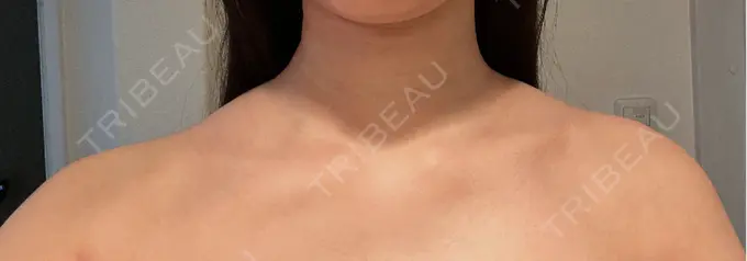 ボトックス（肩） ヴァージンクリニック 福岡天神院 AFTER メイン用