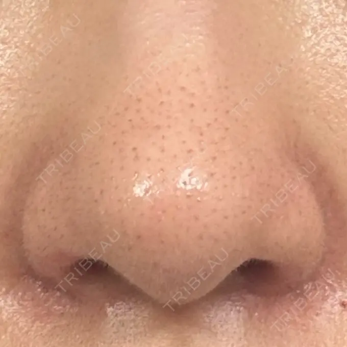 鼻孔縁挙上 シエルクリニック AFTER メイン用