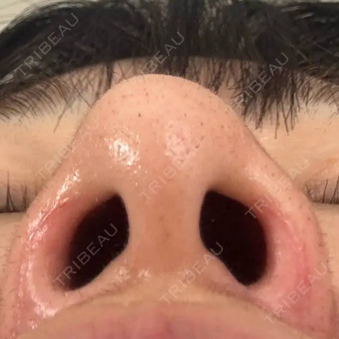 鼻孔縁挙上 シエルクリニック DAY 61 メイン用