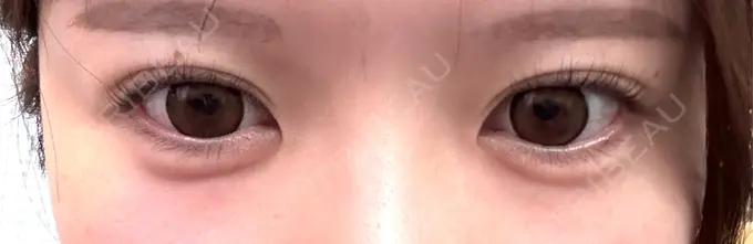 ヒアルロン酸注入（涙袋） / ヒアルロン酸注入（あご） / ボトックス（エラ・小顔） フィラークリニック 名古屋栄院 DAY 0 メイン用