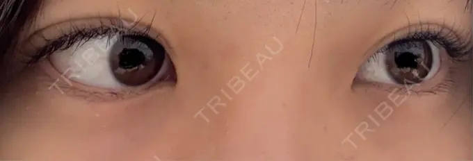 二重埋没 / 目元修正 水の森美容クリニック 東京渋谷院 AFTER メイン用