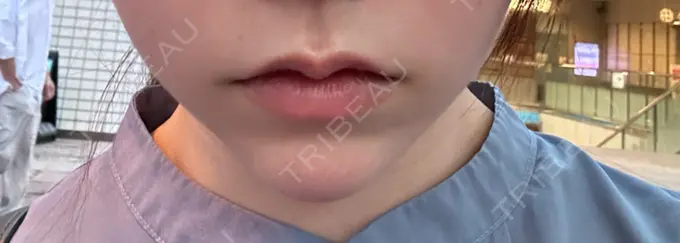 ヒアルロン酸注入（涙袋） / ヒアルロン酸注入（あご） / ボトックス（エラ・小顔） フィラークリニック 名古屋栄院 DAY 0 メイン用