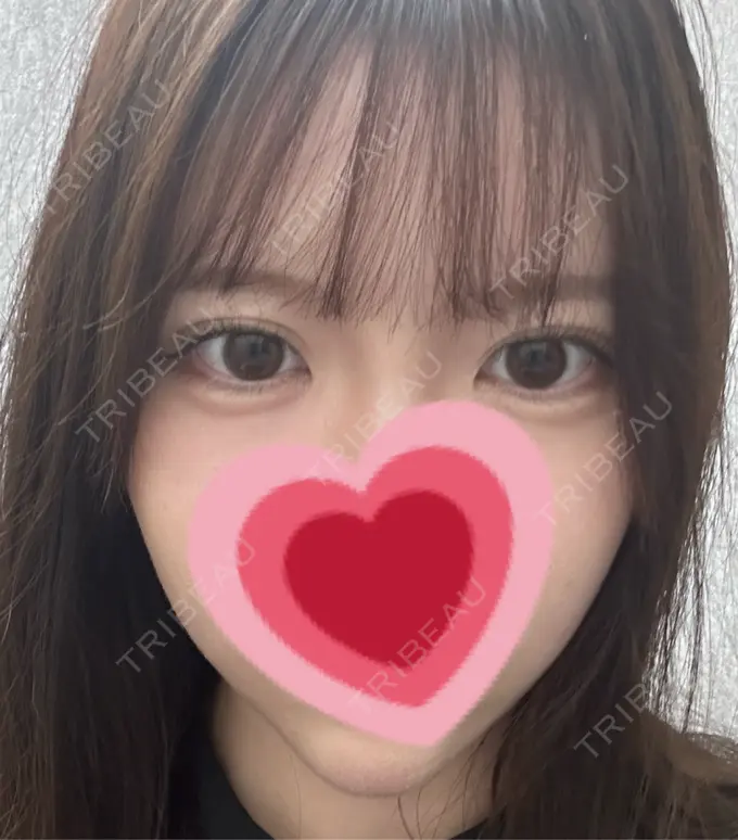 ヒアルロン酸注入（涙袋） / ヒアルロン酸注入（あご） / ボトックス（エラ・小顔） フィラークリニック 名古屋栄院 AFTER メイン用