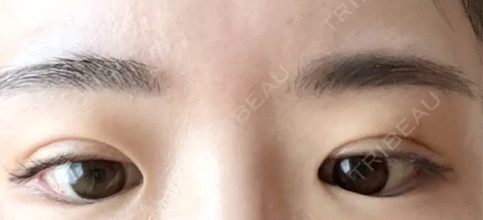 二重埋没 OMI CLINIC 【オミクリニック】 DAY 4 メイン用