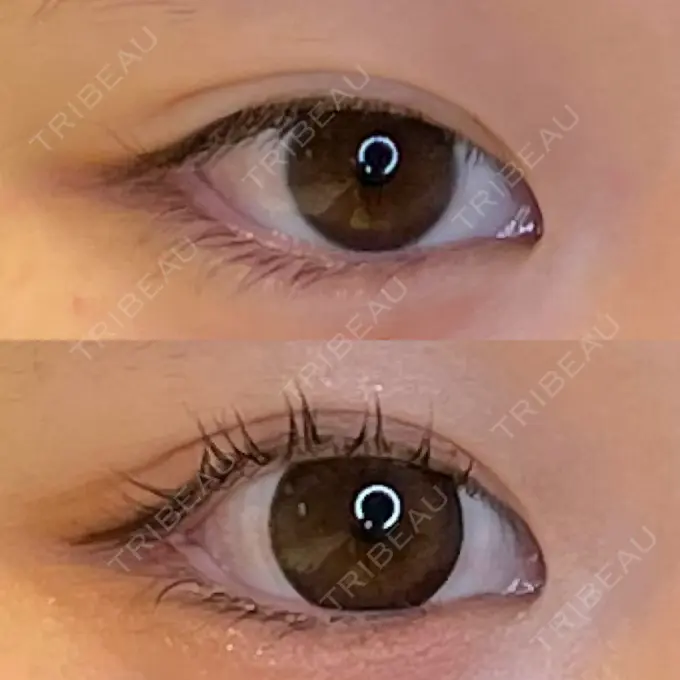 目尻切開 / タレ目形成・グラマラスライン（埋没） LOUIS CLINIC 二子玉川院【ルイクリニック】 AFTER メイン用