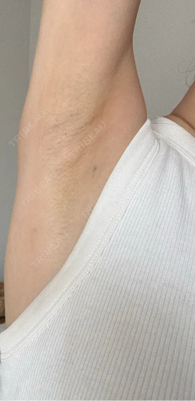 ワキ汗治療（レーザー） ルラ美容クリニック 渋谷本院 AFTER メイン用