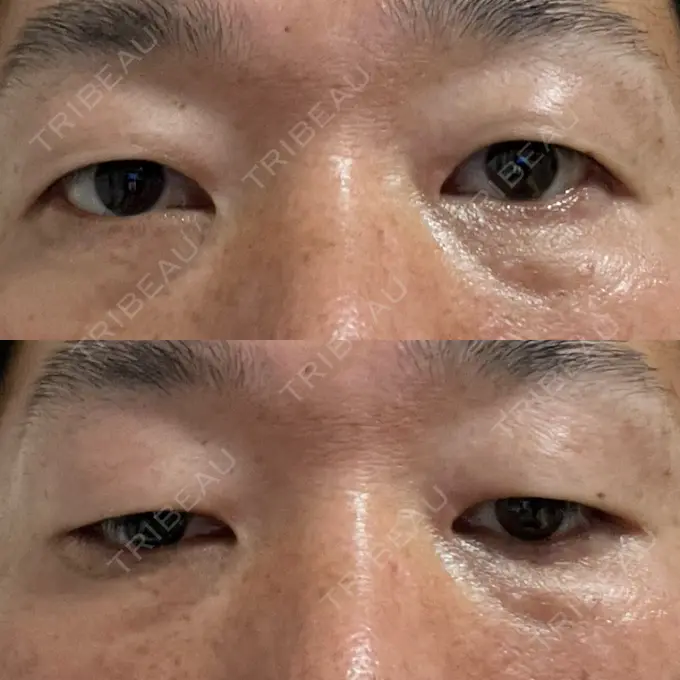 クマ治療 / 下まぶたの脂肪取り ROOTS Clinic DAY 14 メイン用