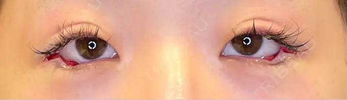 目尻切開 / タレ目形成・グラマラスライン（埋没） LOUIS CLINIC 二子玉川院【ルイクリニック】 DAY 0 メイン用