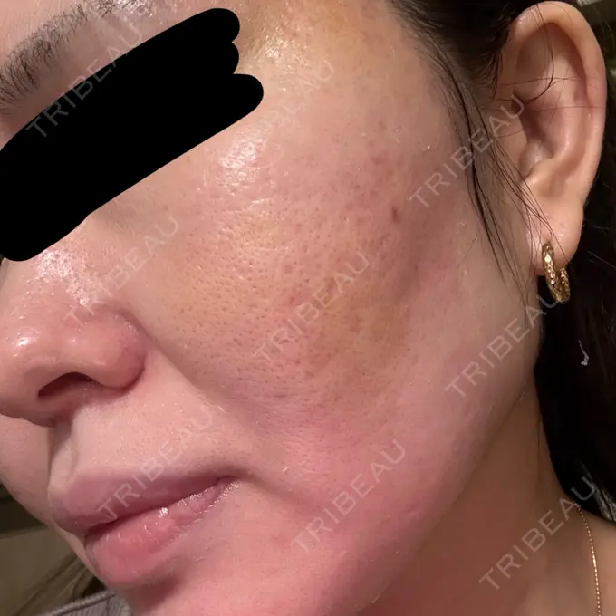 肌ヒアルロン酸注入（たるみ・シワ改善） / サブシジョン 東京シルククリニック 新宿院 DAY 25 メイン用