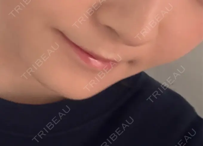 シワ取りボトックス / その他（輪郭） PRISM Beauty Clinic 町田院 DAY 25 メイン用