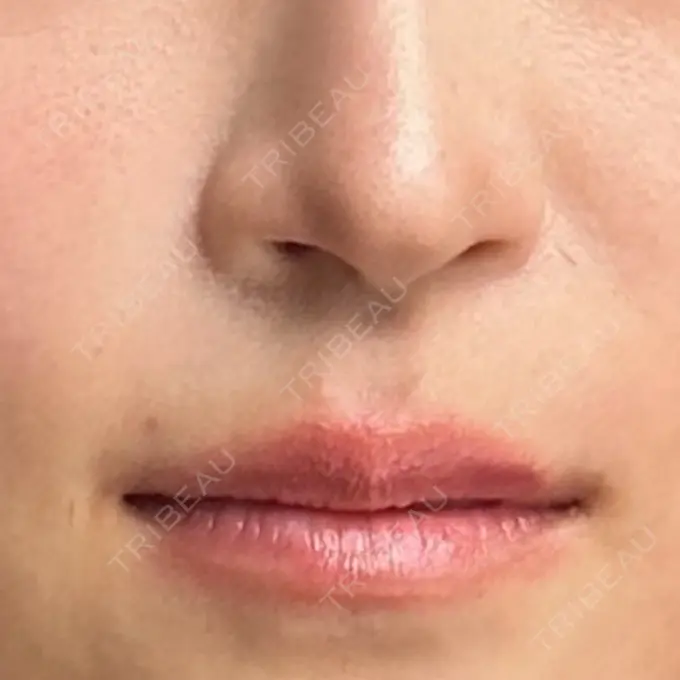 鼻孔縁下降 聖心美容クリニック 名古屋院 DAY 11 メイン用