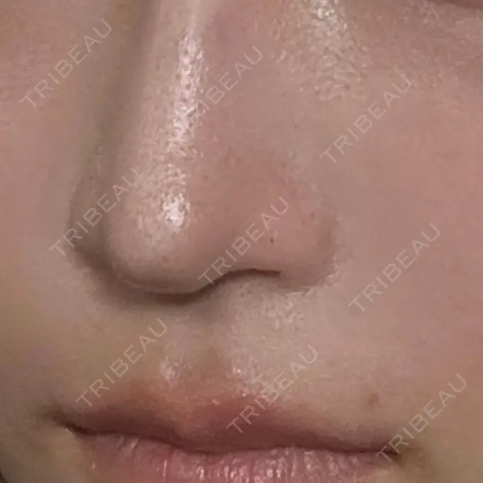 鼻孔縁下降 聖心美容クリニック 名古屋院 DAY 11 メイン用