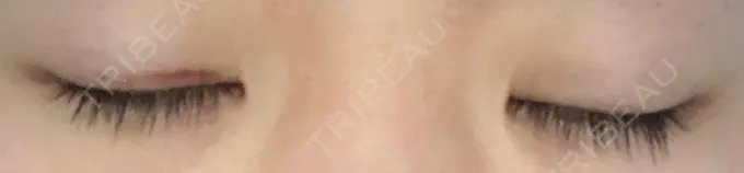 二重埋没 湘南美容クリニック 京都院 DAY 18 メイン用