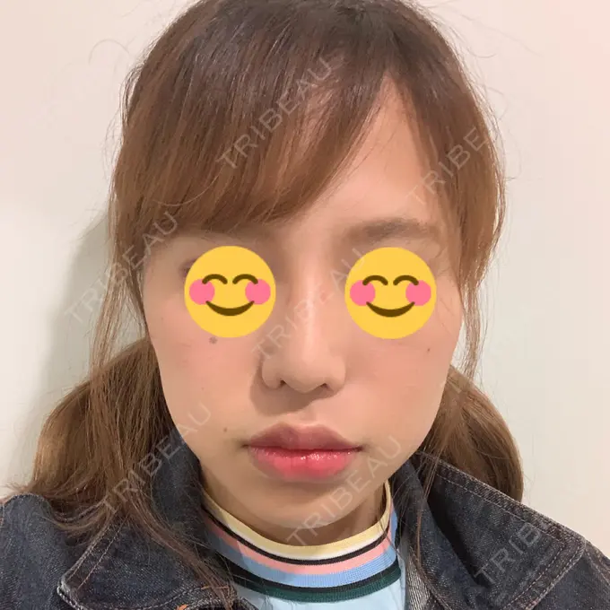 隆鼻術 / 鼻尖形成（切開） / 小鼻縮小（切開） / 軟骨移植 湘南美容クリニック 新橋銀座口院 DAY 53 メイン用