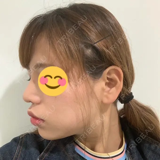 隆鼻術 / 鼻尖形成（切開） / 小鼻縮小（切開） / 軟骨移植 湘南美容クリニック 新橋銀座口院 DAY 53 メイン用