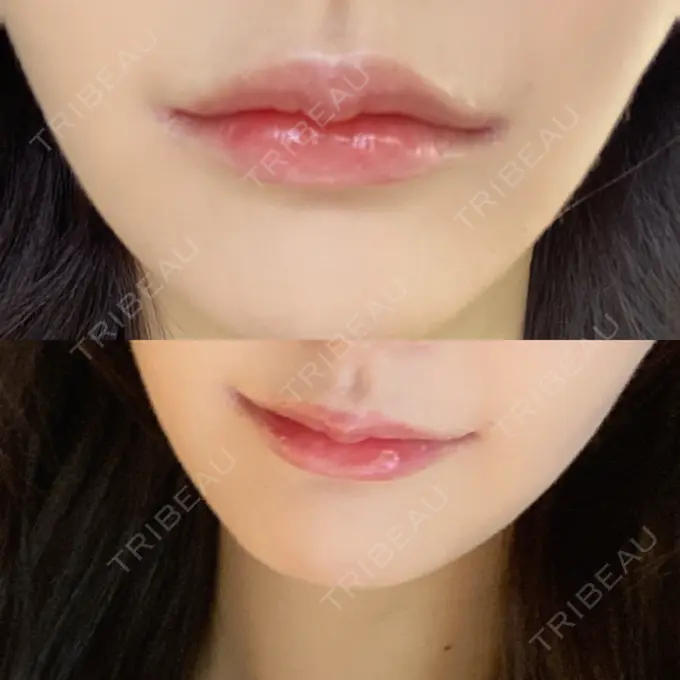 人中短縮 / 口角挙上 R Beauty CLINIC 銀座院 AFTER メイン用