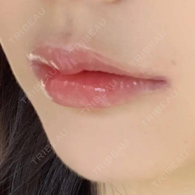 人中短縮 / 口角挙上 R Beauty CLINIC 銀座院 DAY 97 メイン用