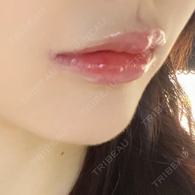 人中短縮 / 口角挙上 R Beauty CLINIC 銀座院 DAY 97 メイン用