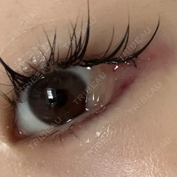 目尻切開 / タレ目形成・グラマラスライン（埋没） LOUIS CLINIC 二子玉川院【ルイクリニック】 DAY 1 メイン用