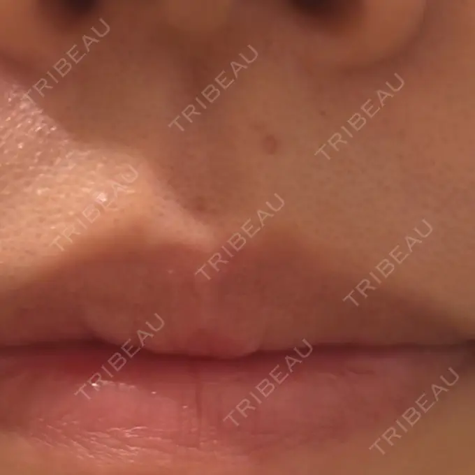 ほくろ・いぼ切除（肌） 吉祥寺アイビークリニック AFTER メイン用