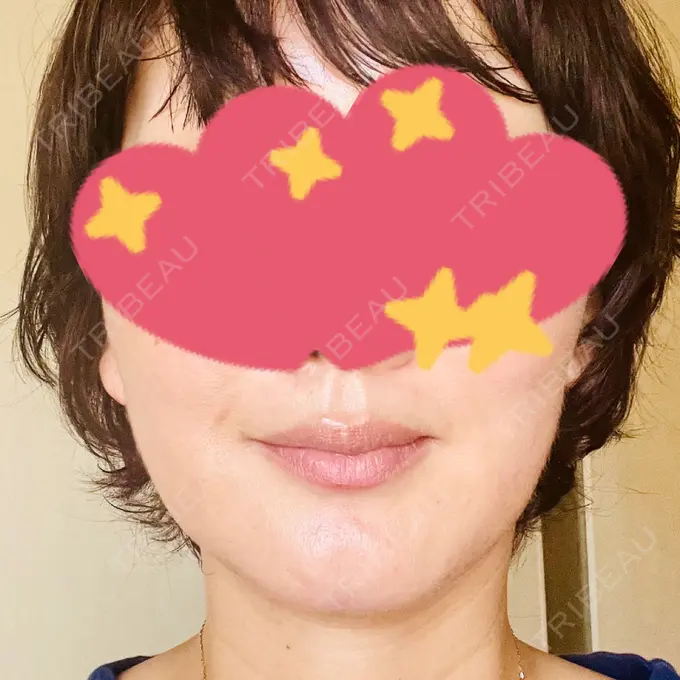 RF（高周波）たるみ治療 / その他（輪郭） DAILY SKIN CLINIC 心斎橋院 DAY 7 メイン用