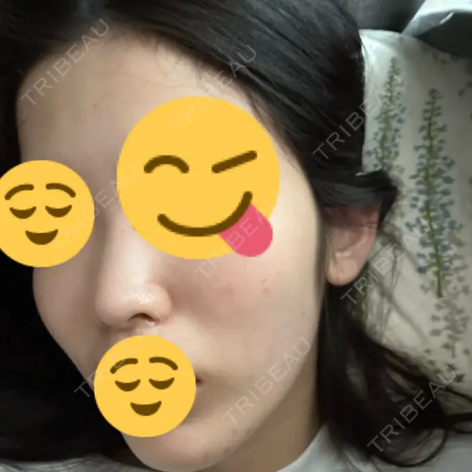 イオン導入 / エレクトロポレーション / 光治療（フォトフェイシャルなど） メディアージュクリニック 大阪梅田院 DAY 7 メイン用