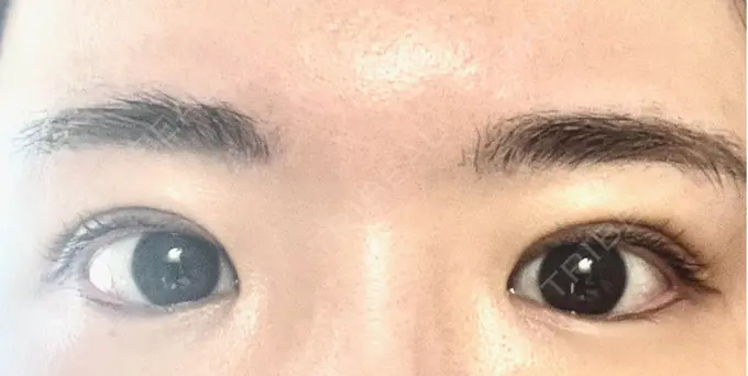 二重埋没 OMI CLINIC 【オミクリニック】 DAY 6 メイン用