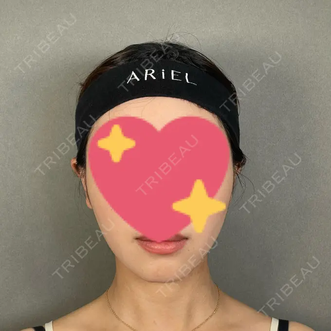 糸リフト / バッカルファット除去 / 脂肪吸引（顔） / ボトックス（エラ・小顔） アリエル美容クリニック 大宮院 AFTER メイン用