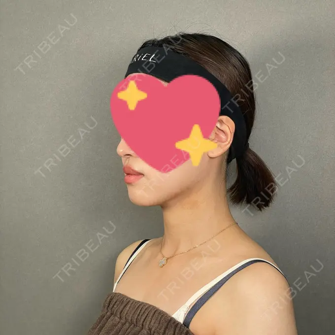 糸リフト / バッカルファット除去 / 脂肪吸引（顔） / ボトックス（エラ・小顔） アリエル美容クリニック 大宮院 DAY 182 メイン用