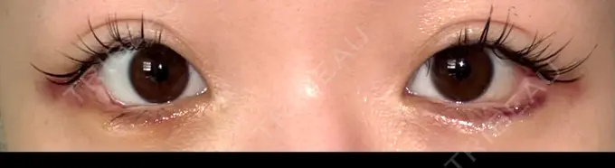 目尻切開 / タレ目形成・グラマラスライン（埋没） LOUIS CLINIC 二子玉川院【ルイクリニック】 DAY 2 メイン用