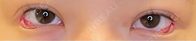 目尻切開 / タレ目形成・グラマラスライン（埋没） LOUIS CLINIC 二子玉川院【ルイクリニック】 DAY 0 メイン用